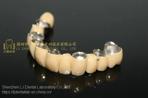 Dental Crown Composite, Dental Teeth, Dental Prosthesis, Laboratoire Dentaire, Dentallabor, Laboratorio Dental, Dental Laboratory, Shenzhen LJ Dental Lab China photo-2
