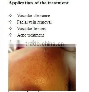 High Frequency Vascular Remvoal Machine/Beauty Salon Used Vascular Remvoal Device for Sale photo-5
