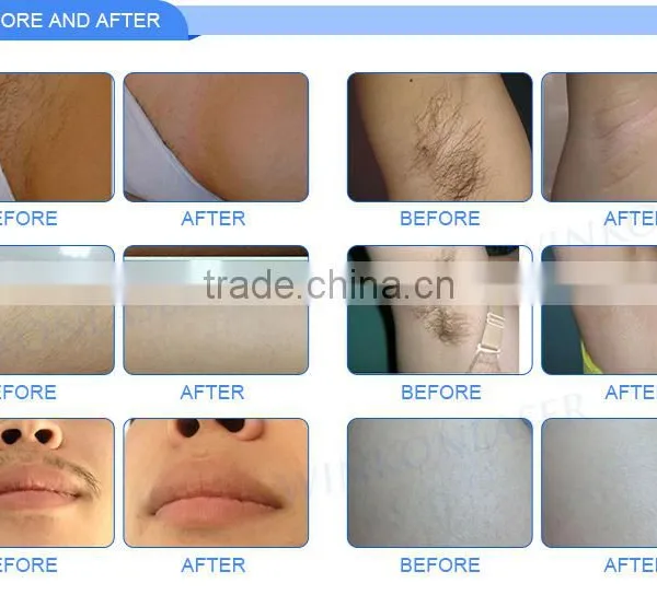 High Quality Vertical Espil Ipl Hair Removal for All Skins photo-4