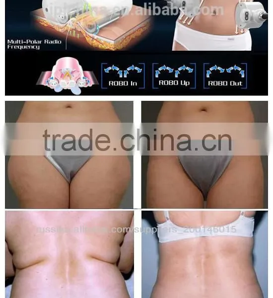 2015 Radio Frequency Rolling Guangzhou Beauty FSWT Machine Wholesaler photo-3