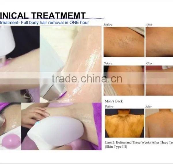 Permanent Laser Hair Removal Machines Home photo-5
