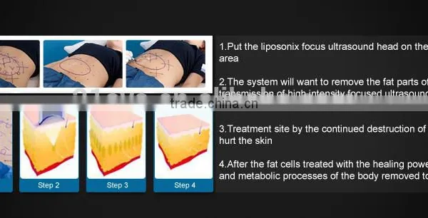 Nasolabial Folds Removal Liposonix High Intensity Focused High Frequency Acne Machine Ultrasound HIFU Body Slimming Machine Face Lifting photo-6