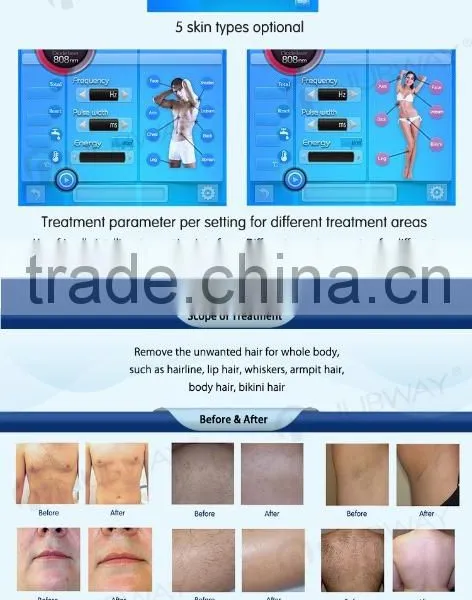 2017 New Design Alexandrite Laser/ Lightsheer Diode Laser/ 808nm Diode Laser Hair Removal Machine With CE photo-3