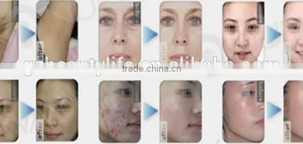Unique Design Portable IPL Laser Hair Removal Machine photo-6