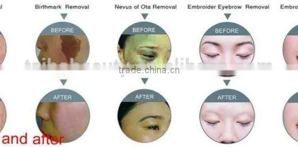 2015 Chrismas Promotion USd1200!! ND Yag Laser Tattoo Remover Portable / Mini Home Use Tattoo Removal nd Yag Laser photo-5