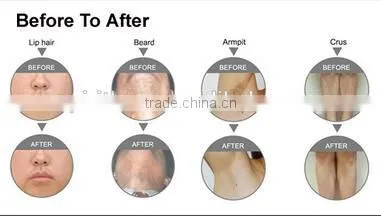 Discount Screen Logo Customized Nd Yag Laser Hair Removal Nd Yag Laser Ipl photo-2