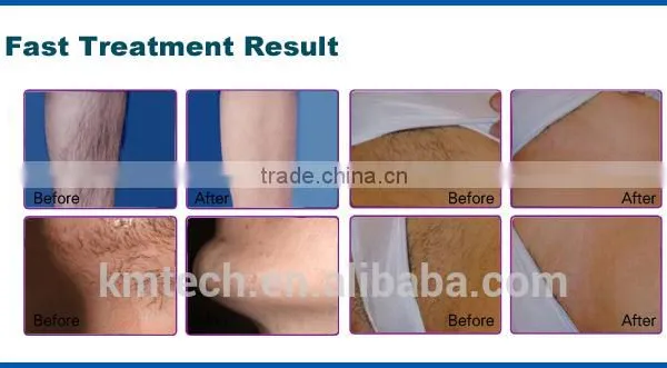 CE ISO Approved Portable Medical 808nm Diode Laser Hair Removal Machine With 160J/cm3 Energy photo-2