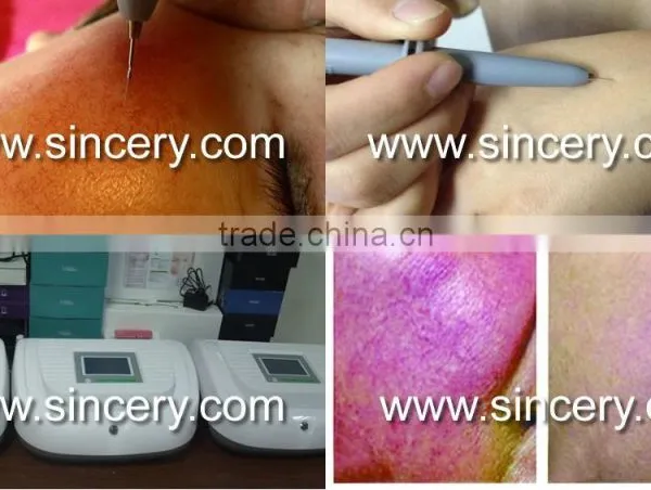 High Frequency Vascular Removal Red Spider photo-3