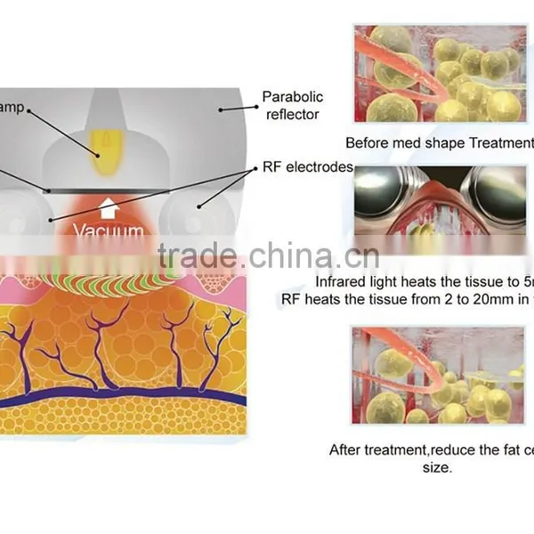 Best Fat Reduction Sincoheren Cellulite Reduction Machine Kumashape III and KumashapeII photo-4
