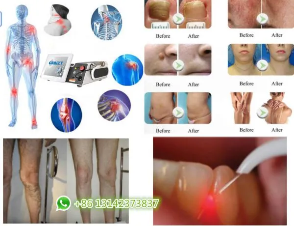 Clinic Use Diode Laser Device 980nm 1470nm Combined Two Wavelength Physical Therapy Vascular Removal Nail Fungus Removal photo-4