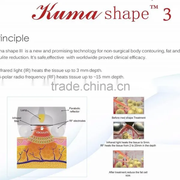 Vacuum Body Massager Anti Cellulite Suction Machine Radiofrequency Machine photo-3