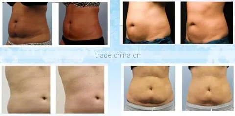 Best Sell Product Cryolipolysis Fat Freeze Loss Increasing Muscle Tone Weight Slimming Belts Machine For Spa Clinic Hospital 50 / 60Hz photo-5