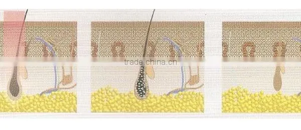 12x12mm 808nm Diode Medical Pain-Free Laser For Hair Removal photo-2