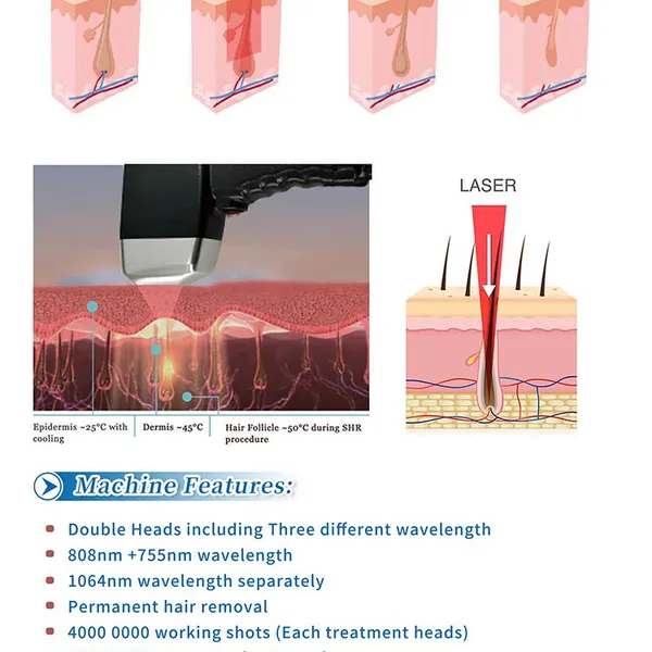 Industrial Standard 755nm Laser Hair Removal Equipment for Salons photo-4