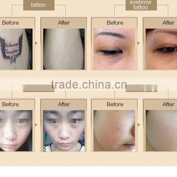 800mj New Styel Laser Picosure/laser Tattoo Removal Machine Price Pigmented Lesions Treatment photo-5