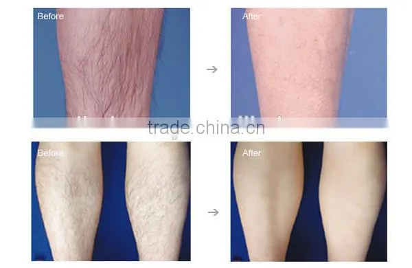 Salon 2016 Permanent Hair Removal SHR IPL/SHR IPL Laser/SHR IPL Hair Removal Machine Pigment Removal photo-6