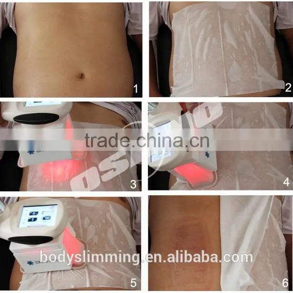 Professional Cryo Fat Device Vacuum Cellulite Freezing photo-4
