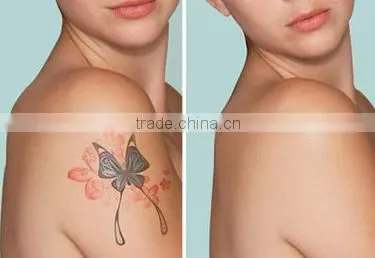0.5HZ Q Switched Nd Yag Pigmented Lesions Treatment Laser Tattoo Removal Beauty Equipment photo-6