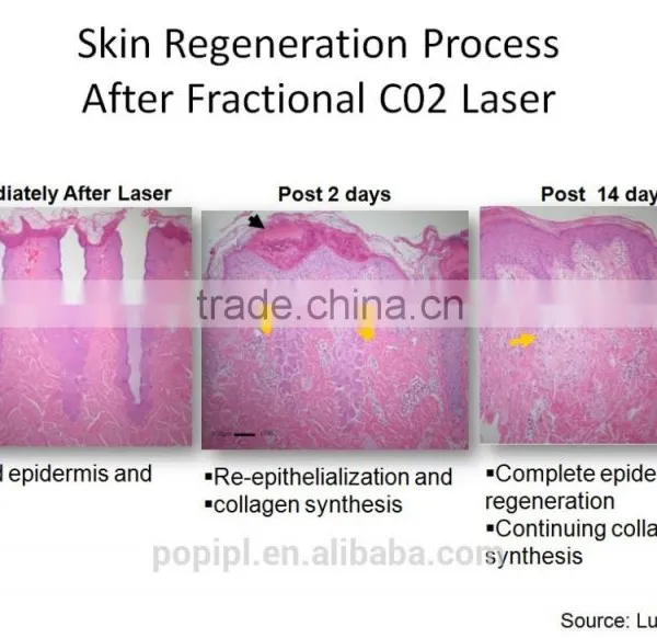 RF Co2 Fractional Laser Fractional Laser Treatment photo-2