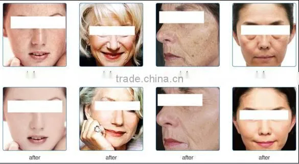 PDT LED Blue and Red Light Therapy &PDT Skin Care Beauty Equipment photo-5