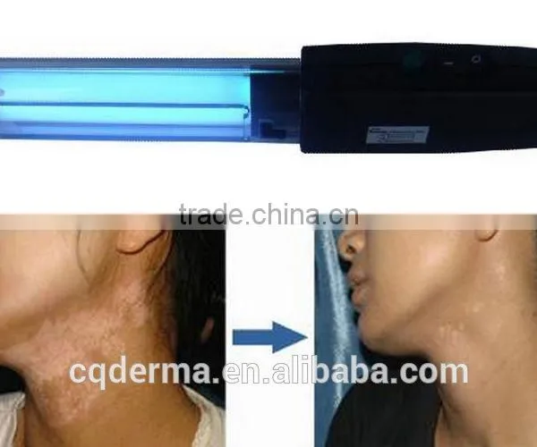 Home Use Portable UV Phototherapy 311nm Narrow Band Uvb Lamp for Psoriasis Treatment Vitiligo Treatment photo-2