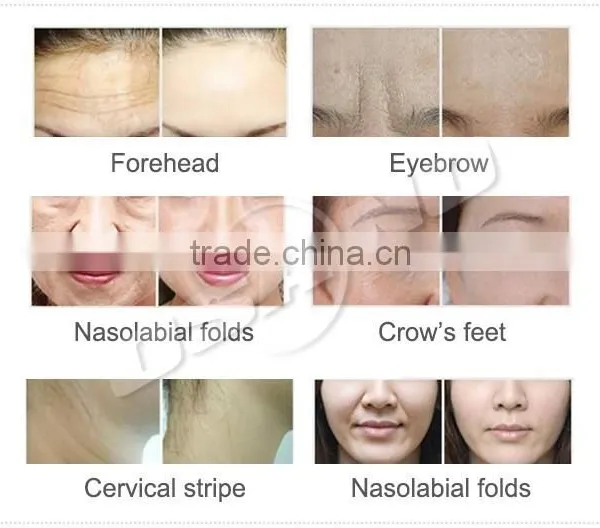 LM-E300A Portable Skin Tightening Radio Frequency Body Machine photo-6