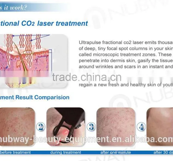 Ultra Pulse Pigmentation Removal CO2 Laser Resurfacing Machine photo-3