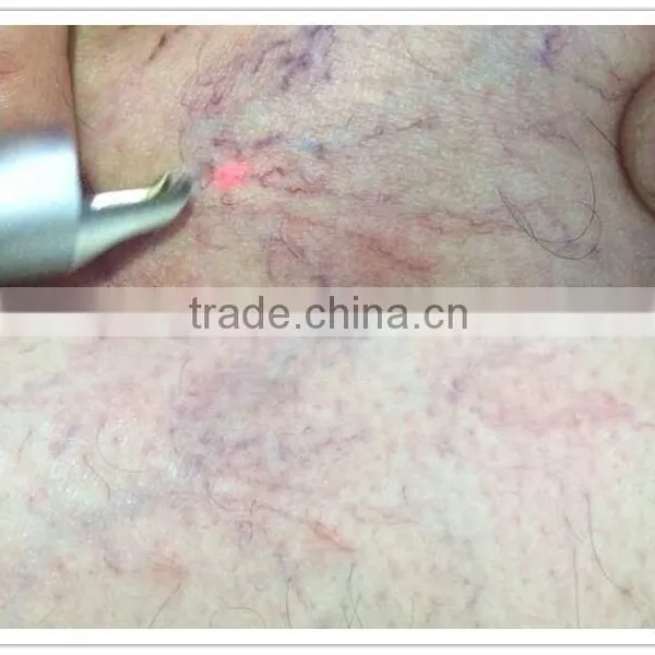 2016 New 980nm Diode Laser for Vascular Removal Blood Vessels Removal/anti-redness Remover/skin Care photo-2
