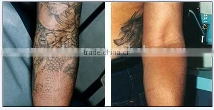 Q-switched Ndyag Laser,professional for Tattoo,pigment ,eyebrow Removal photo-6