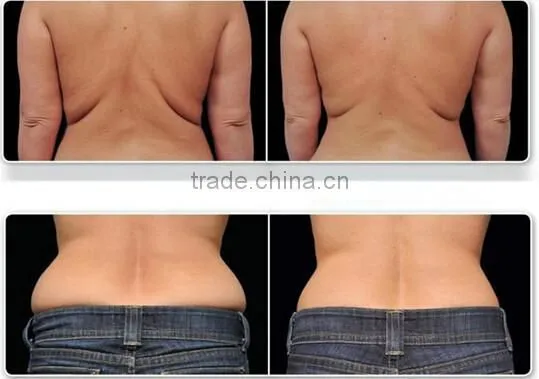 Factory Provide Cryolipolysis Increasing Muscle Tone Fast Slimming Machine Cellulite Reduction photo-6
