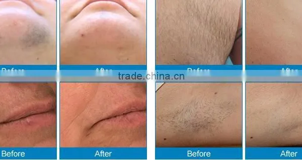 Fine Lines Removal Wholesale Price Multifunctional Medical E-light Ipl And Rf For Hair Removal photo-5