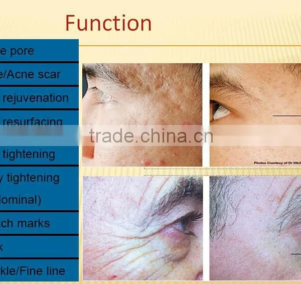 New Technology Professional Wrinkle Remove PINXEL rf Fractional Micro Needle Machine / Micro Needle rf / Vein Stopper photo-6