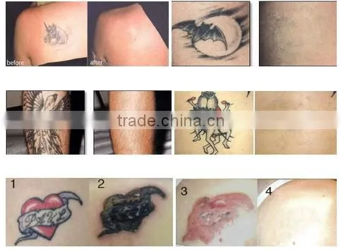 Facial Veins Treatment Fashionable Updated Beauty Nd 1000W Yag Machine For Tattoo Laser /scar Removal 532nm photo-6