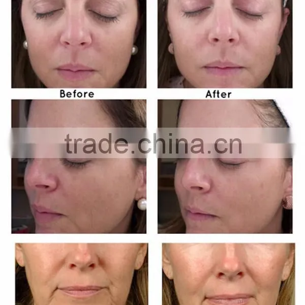 Skin Tightening HIFU Machine Anti Wrinkle 5.0-25mm Machine High Intensity Frequency Hifu Facial Machine 4MHZ photo-6