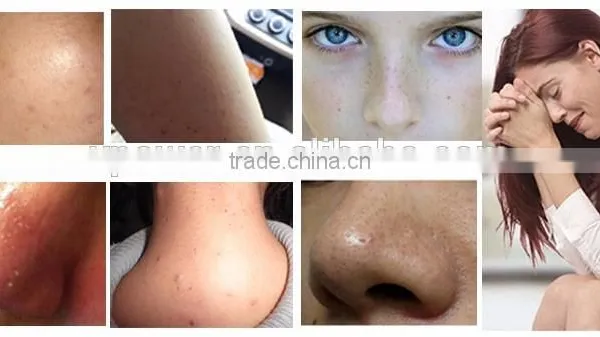 2017 Most Popular Blackhead Remover Vacuum Blackhead Remover photo-6
