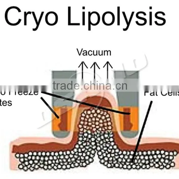 Fat Reduction Portable Cryolipolysis Body Slimming Machine /4 Cryo Heads Flabby Skin photo-3