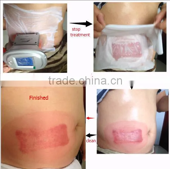 4 Handles Professional Cryolipolysis Device With 2 Heads Working Simultaneously photo-2