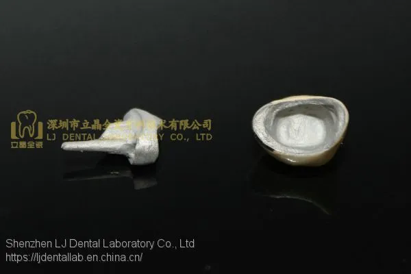 Full Metal Post Core, Full Ceramic Post Core, Richmond Crown, Cast Metal Crown, Dental Prostheses, Laboratorio Dental, Dental Laboratory, Dentallabor, LJ Dental Lab China photo-3