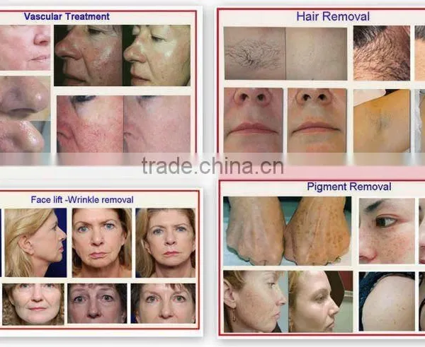 Vascular Treatment Best Effective And High Quality Portable Ipl 2.6MHZ Hair Removal Skin Care Machine For Home Use And Hospital 10MHz photo-6