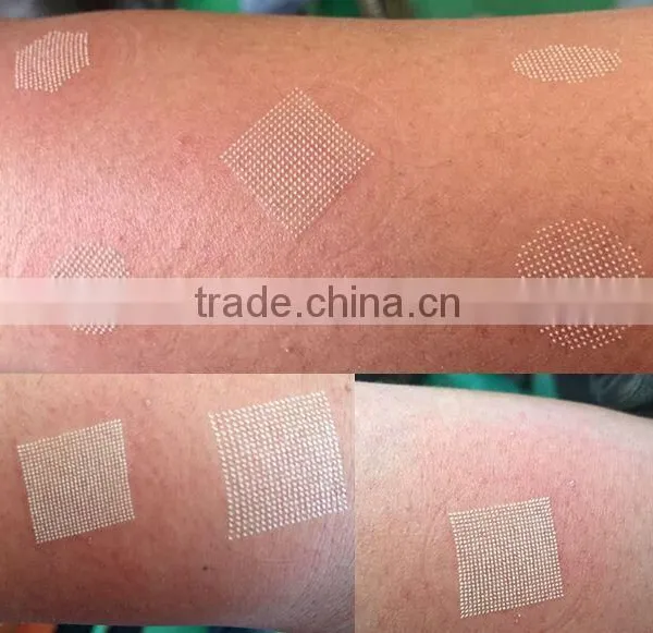 Sanhe Fractional Laser Co2 Skin Tightening System/ Co2 Glass Laser Tube photo-3