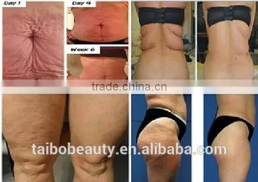220 / 110V Cheapest!!! Cryolipolysis Fat Freezing Machine/fat Lose Weight Freezing Liposuction Machine/slim Freeze Belt photo-6