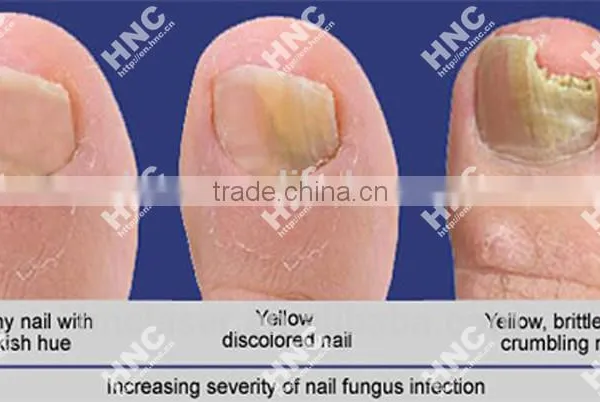 Nail Infection Control Products Made in China Market photo-6