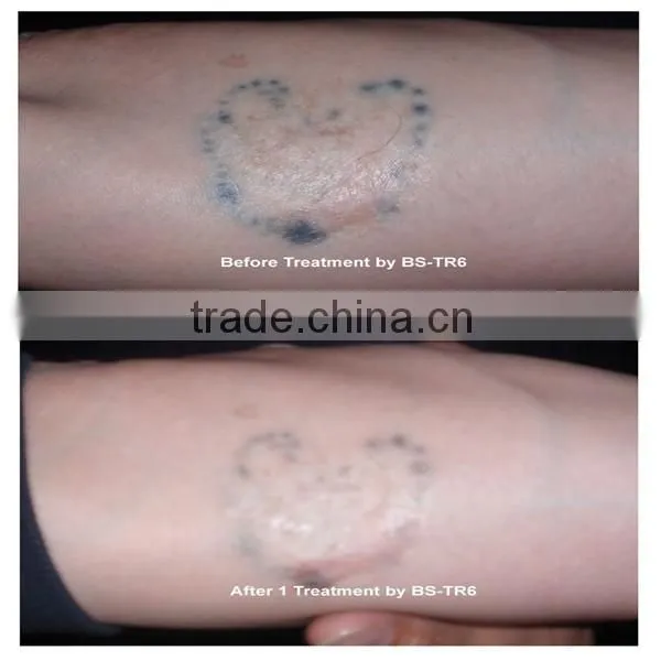 Naevus Of Ota Removal Q- Switch Nd Q Switch Laser Machine Yag Laser Tattoo Removal System/machine Varicose Veins Treatment photo-5