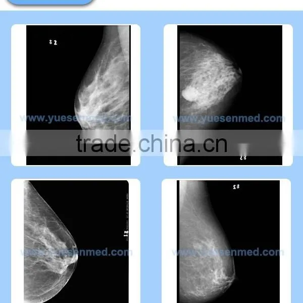 High Frequency Fixed or Rotating Anode Cheapest Mammography x Ray Price photo-5