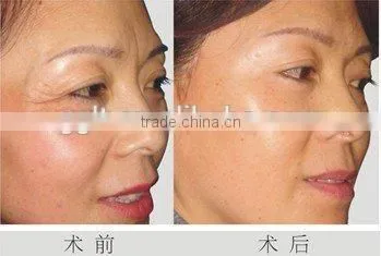 New Designed Bipolar RF Skin Tightening Face Lifting Beauty Equipment Price photo-5