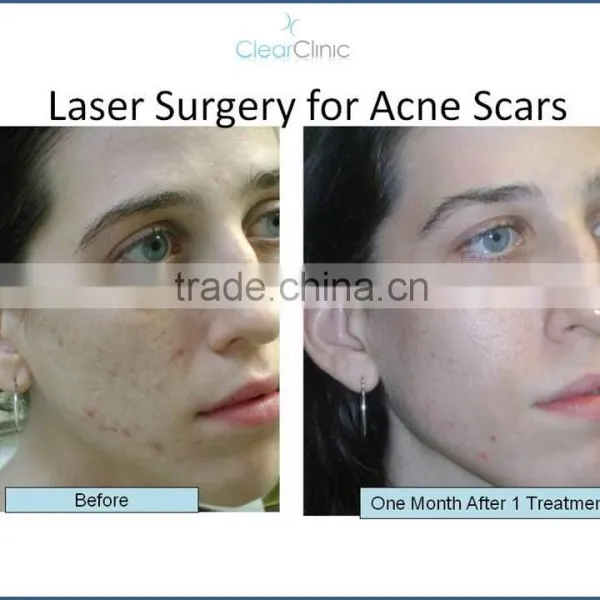 Acne Treatment Skin Rejuvenation Skin Tightening er Yag Laser Scar CO2 Laser photo-6