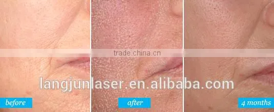 Fractional Co2 Laser Skin Resurfacing RF And Stretch Mark Removal Machine 40w photo-2