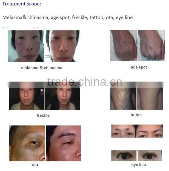 Professional Mini C6 High Energy Laser Spot Removal Factory Sale photo-5