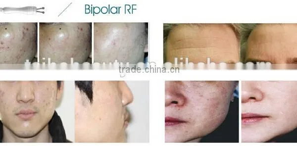 The Multifunctional and Effective Portable HIFU Focused Ultrasonic Fat Removal for Beauty Center and Clinic photo-6