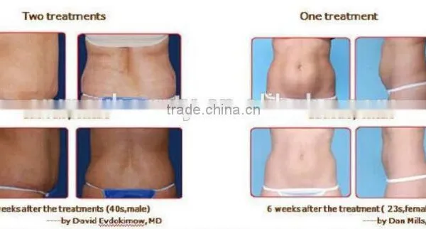 Popular Portable Fat Freezing Machine For Lose Weight photo-6